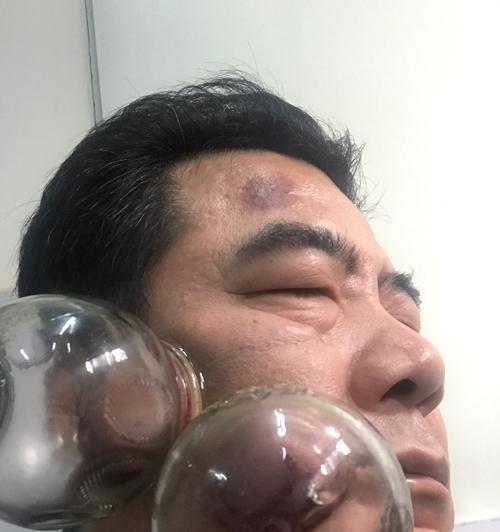 神医放血治疗通关攻略？治疗过程中需要注意哪些常见问题？-第1张图片-西柚游戏